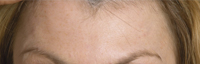 Botox Forehead